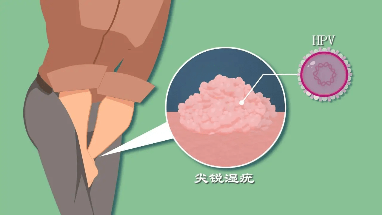 濕銳尖疣注意事項，了解、預(yù)防與護(hù)理的關(guān)鍵步驟，濕銳尖疣注意事項詳解，了解、預(yù)防與護(hù)理的關(guān)鍵步驟指南